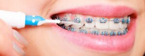 orthodontic products